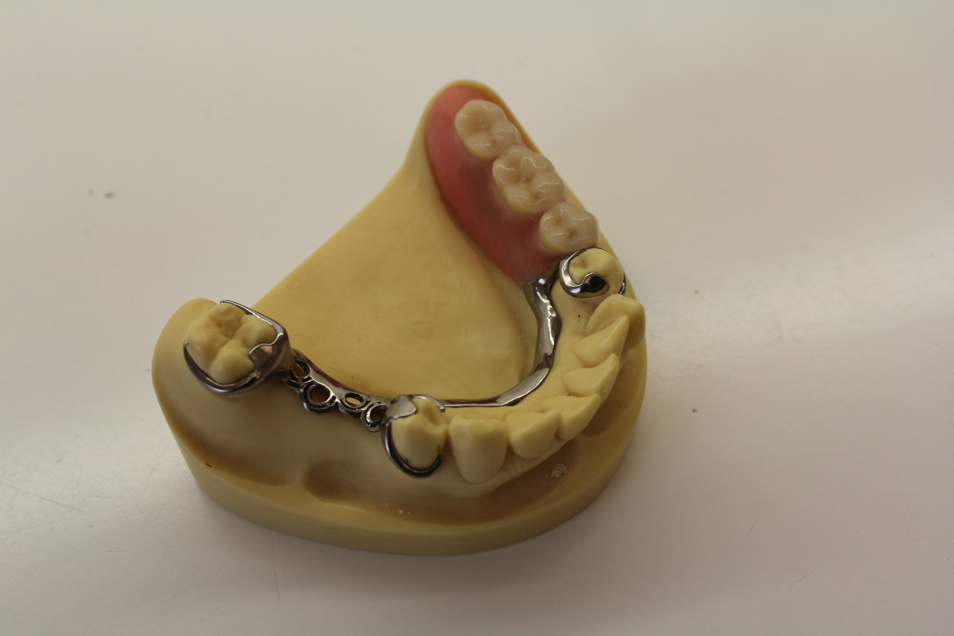 Partial denture with metal clasps